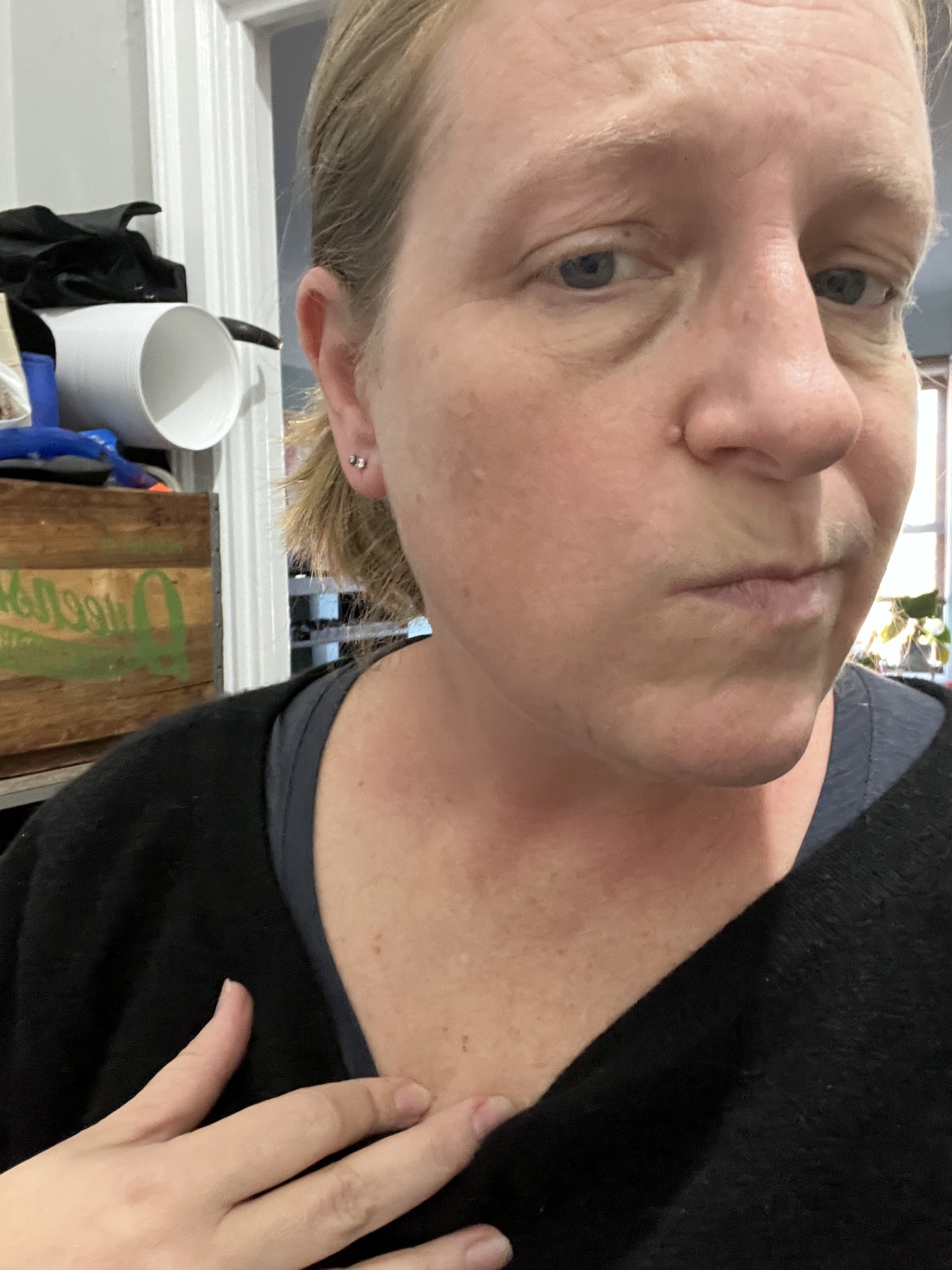 selfie of a middle-aged woman showing a rash on her neck